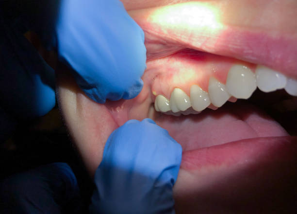Best Emergency Treatment for Toothache in Cordaville, MA